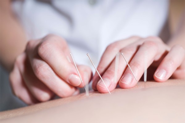 Efectividad de la Acupuntura en el Tratamiento del Dolor Efectividad de la Acupuntura en el Tratamiento del Dolor